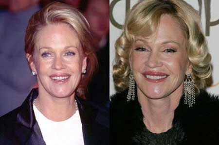 اخبار,اخبار فرهنگی , جراحی‌های زیبایی در میان هنرمندان